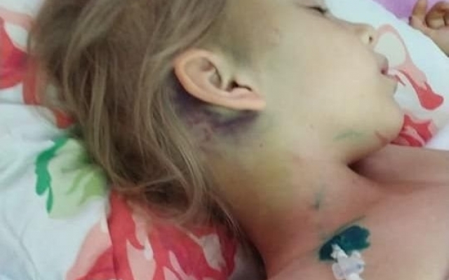 Жителей Николаева просят помочь девочке, которая упала с 3-хметровой высоты и сломала шею Фото № 1 Жителей Николаева просят помочь девочке, которая упала с 3-хметровой высоты и сломала шею Фото № 1