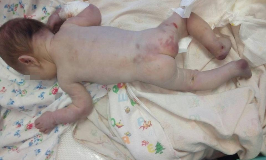 В Первомайске неизвестные подбросили в больницу сильно избитого новорожденного ребенка (фото 18+)
